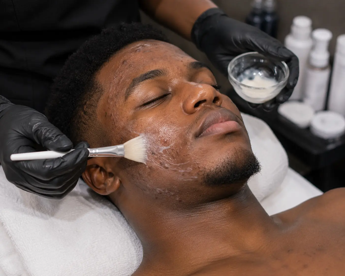 Acne facial treatment for a male client at Beauty by Byss